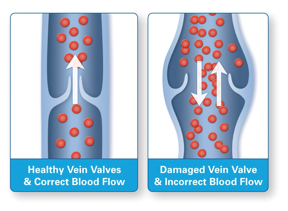 healthy and diseased valves